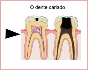 dente cariado